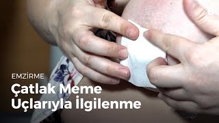 Çatlak meme uçlarıyla İlgİlenme