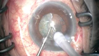 eye with 2 failed tubes: phaco-trabectome, goniosynechiolysis + posterior synechiolysis