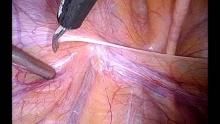 part 1 Orchiectomy