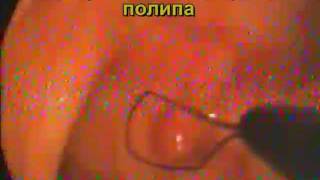 Три полипа "сигмы". Удаление петлёй.