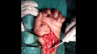 Trauma de Mano, lesión tendinosa flexora compleja 03