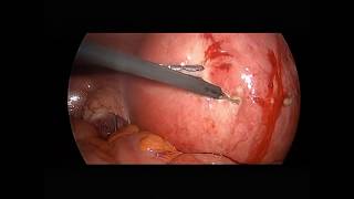 استئصال ليف رحمي بالمنظار مع التقطيع داخل كيس عزل. Laparoscopic myomectomy, inbag morcellation