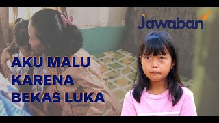 #SuperStory Minder Karena Luka Tersiram Air Panas | Aprilita Loys