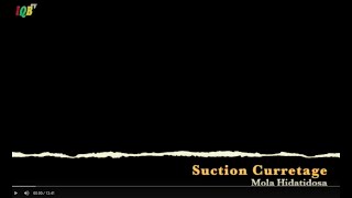 Suction Curretage