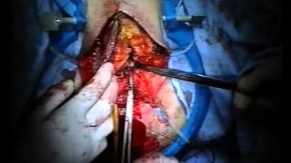 VULVECTOMIA (VULVECTOMY) - Op.: dr G. Boccia - dr C. Festa - ost. A.Veneri - an. dr G. Bisogno)