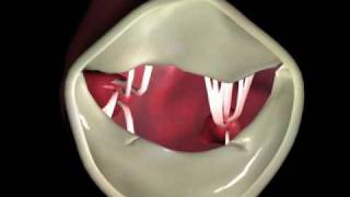 Heart - Flail Posterior Mitral Valve Leaflet