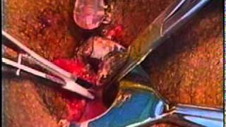 Hemorrhoidectomy with Starion Thermal Welding System