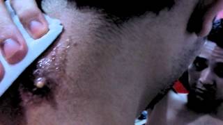 Piercing surface na nuca inflamado, ultimo estágio