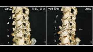 頚椎症 手術の術前術後MRIとCT 手術動画 執刀医：すずかけセントラル病院 土屋直人先生