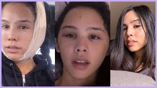 I Got Facial Feminization Surgery | MTF Transition