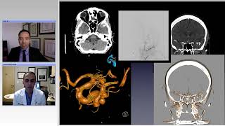 Revascularization Techniques for Treatment of Complex Aneurysms