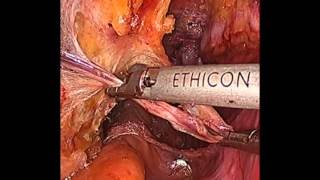 Laparoscopic Radical Prostatectomy : Dr. Shailesh Puntambekar