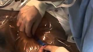 [PTTH] Đặt Catheter Tĩnh Mạch Dưới Đòn Part 4