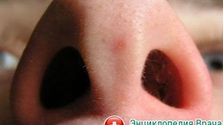 Удаления гноя из пор носа/Squeezing blackheads