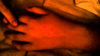 My fat hand after accident