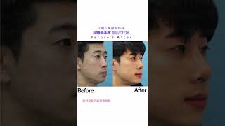 [Ksamsung TV Global] KS Rhinoplasty, Bent nose, Hooked nose 鼻子整形, 歪鼻子, 鼻子修复手术 做完鼻子后的改变, 鼻子