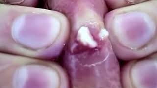 Прыщи подборка Часть № 3 Pimple assembly part № 3