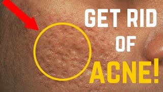 5 Ways to Remove Acne Scars, Dark Spots & Fine Lines FAST!