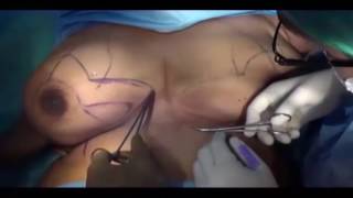 Bilateral Macromastia inferior pedicle technique