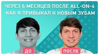 Привыкание к новым зубам после All-on-4
