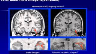 Devynioliktoji tema: Depresija. Diagnositka ir gydymas