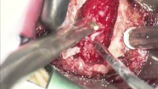 Dr. Casden Performs Anterior Cervical Spine Surgery