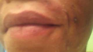 12.5% TCA Peel ~ My journey to a clear face!