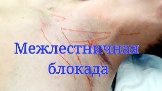 Межлестничная блокада плечевого сплетения