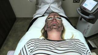 Spectra Laser Facial
