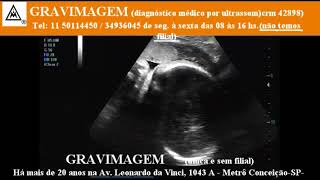 GRAVIMAGEM 21564 Ultrassom morfolígico 3d 4d em gravidez 32 semanas mp1