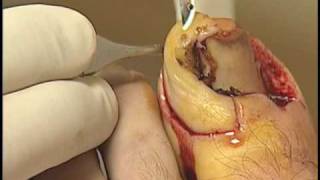 Vandenbos procedure for ingrown toenails