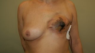 Epigastric Flap for Nipple Skin Sparing Mastectomy Necrosis