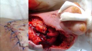 Dr.Mehrdad Mehrabi (3)Diabetic Foot Ulcer Treatment (DFUs), Amputation