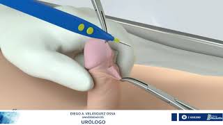 PLASTIA DE FRENILLO DEL PENE -   FRENULOPLASTIA
