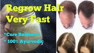 REGROW HAIR NATURALLY FROM ROOTS, TREAT/CURE BALDNESS for MEN and WOMEN in HINDI 100% GUARANTEE