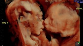 Mom-To-Be Shocked When Her Twins Were Caught Kissing On Sonogram