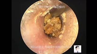 Ear wax removal extraction 2020