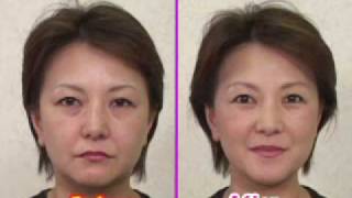 目の下のたるみをリフトアップ目の下のたるみに