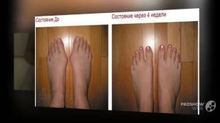 плоско вальгусная деформация стопы лечение

  - Valgus Pro по лучшей цене?