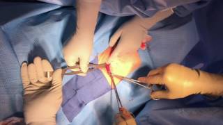 Easy Postpartum Tubal Ligation