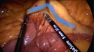 Laparoscopic Splenic Flexure Mobilization: Step by Step (with caption and animation)
