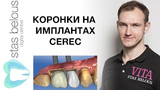 #Стоматолог Стас Белоус КОРОНКИ НА ИМПЛАНТАХ Cad/Cam #CEREC screw retained crowns  implants #ANKYLOS
