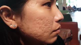 เอจเลส เจอเนส Instantly Ageless Jeunesse ช่วยลดหลุมสิวได้รวดเร็วทันใจ