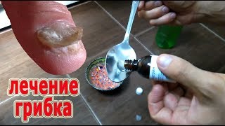 ★Как лечить грибок с помощью уксуса и глицерина. Это средство поможет.