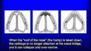 What are Spreader Grafts - by Rhinoplasty Specialist Dr. Becker in New Jersey