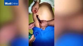 A Rat Get Pulled From A Man’s Belly Button