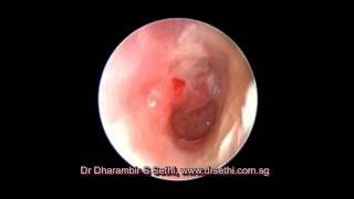 Otoendoscopy Acute Otitis Media