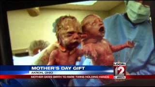 Mother gives birth to rare twins holding hands