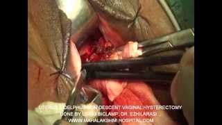 Uterus didelphus- Non Descent vaginal Hysterectomy Done by ezhilarasi karthikeyan