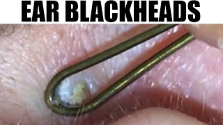 Ear Blackheads & Bonus Pickle Popping! MUST WATCH